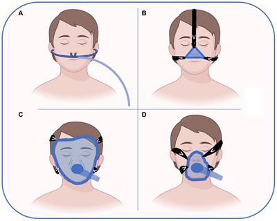 Noninvasive respiratory support in the perioperative setting: a narrative review